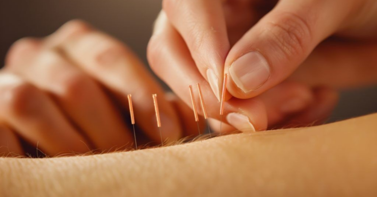 The Benefits of TCM Acupuncture: Unlocking Your Path to Wellness